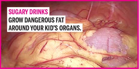 Las bebidas azucaradas pueden conducir a un aumento de la grasa visceral, la cual se acumula alrededor de los órganos.