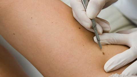 Un doctor remueve un melanoma (der.) de la piel  de un paciente con cáncer.