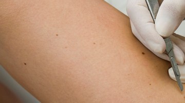 Un doctor remueve un melanoma (der.) de la piel  de un paciente con cáncer.