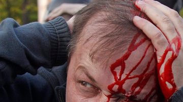 Un manifestante herido que protestaba contra la investidura de Vladimir Putin, en Moscú, Rusia.