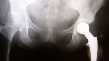 Los implantes de cadera pueden ser de metal,  cerámica o una combinación de  metal o cerámica con plástico.
