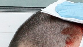 Un manifestante  con golpes en la cabeza.