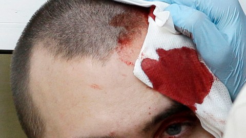 Un manifestante  con golpes en la cabeza.