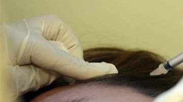 Una combinación de botox y terapia celular brinda buenos resultados.