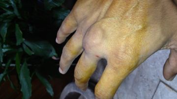 Así luce la mano del boxeador mexicano Rafael Márquez, por lo que no está en condiciones de enfrentar a Wilfredo Vázquez Jr.