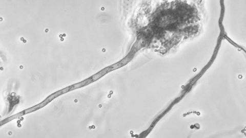 Las inyecciones contra el dolor de espalda podrían causar meningitis.