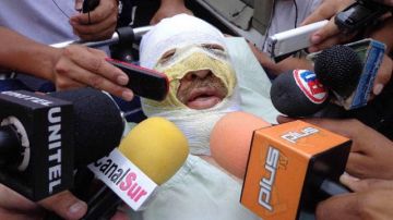 El periodista boliviano Fernando Vidal, haciendo declaraciones a los medios en Yacuiba, Bolivia, donde fue quemado por desconocidos cuando conducía un programa radial.