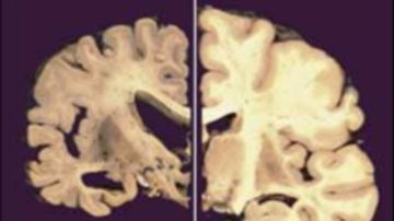 Una sección cruzada de un cerebro; la parte de la derecha está normal y la de la izquierda se encuentra con Alzheimer.