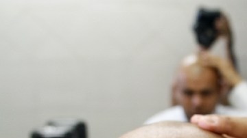 La alopecia es una enfermedad genética.