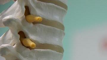 La osteoporosis no es privativa de las mujeres.