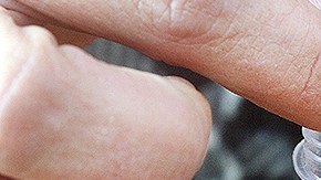 Autoridades sanitarias del país están alertas ante más casos.