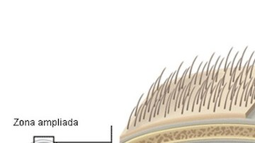 La lesión cerebrovascular de presidenta argentina es una acumulación de sangre entre dos de las tres membranas que recubren el cerebro.