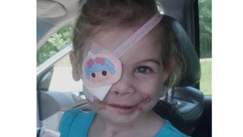 Victoria fue atacada por tres perros de raza pit bull en la casa de su abuelo. Perdió un ojo y movilidad en el lado derecho de su cara.