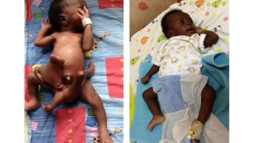El pequeño Paúl Mukisa nació con ocho extremidades, pero tras una operación de tres horas, prevén que será un bebé sano.