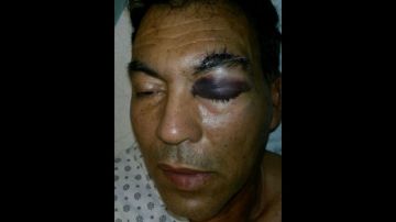 Rafael Grullón espera que le practiquen una cirugía para salvar su ojo.