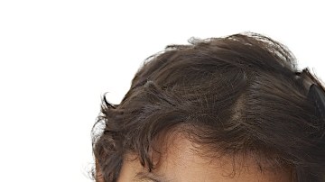 Hasta 12 millones de niños resultan afectados por piojos cada año.