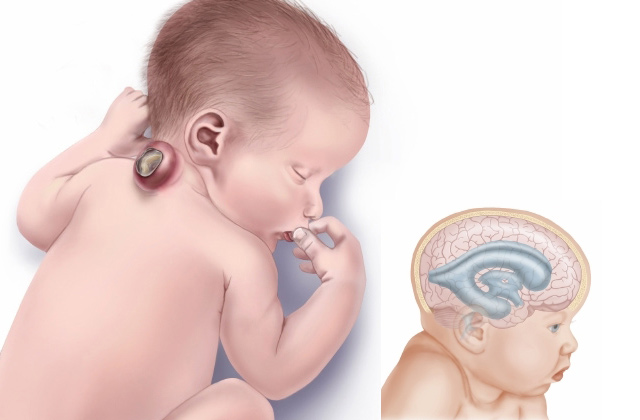 Sin ácido fólico suficiente, la columna vertebral del bebé no se cierra.