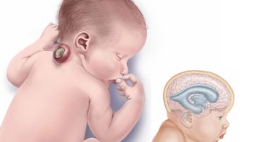 Sin ácido fólico suficiente, la columna vertebral del bebé no se cierra.