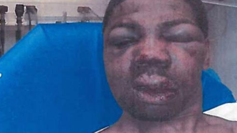Así quedó Hinton luego de recibir una golpiza por parte de oficiales correccionales de  Rikers Island en el 2012.