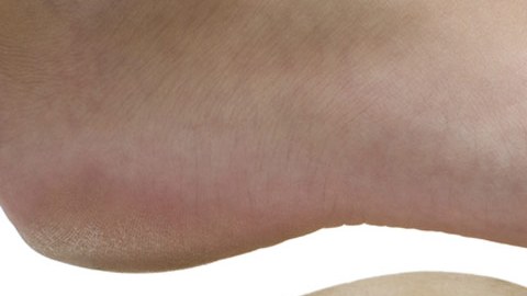 Utilizar calzado y plantillas hechas a medida pueden prevenir ulceraciones causadas por la diabetes.