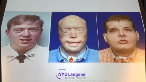 Patrick Hardison antes de sufrir la quemadura, luego con las heridas, y al final tras el trasplante.