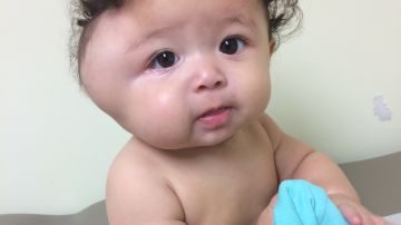 La niña hispana, Camila Alzate nació con una malformación venosa que le originó un tumor de gran tamaño su cara.