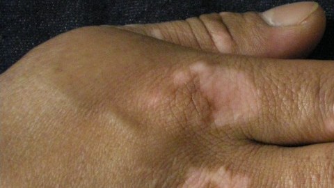 Estuardo Naula, del Ecuador, tenía vitíligo en sus manos y está recibiendo el tratamiento MKT.