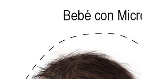 La microcefalia es un defecto congénito en donde la cabeza del bebé es más pequeña de lo esperado en comparación con la de los bebés de la misma edad y sexo.