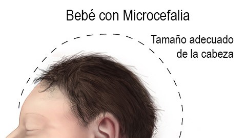 La microcefalia es un defecto congénito en donde la cabeza del bebé es más pequeña de lo esperado en comparación con la de los bebés de la misma edad y sexo.