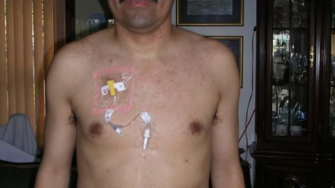 El salvadoreño Guillermo Chacón, poco después de la cirugía en la que le removieron un cáncer de colon avanzado hace 11 años.