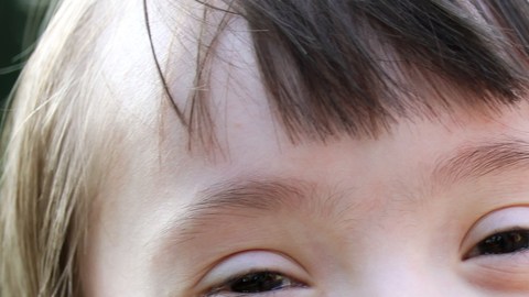 sindrome down