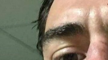 El jugador de rugby subió la imagen de su corte en la nariz en redes sociales.