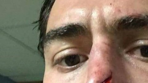 El jugador de rugby subió la imagen de su corte en la nariz en redes sociales.