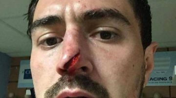 El jugador de rugby subió la imagen de su corte en la nariz en redes sociales.