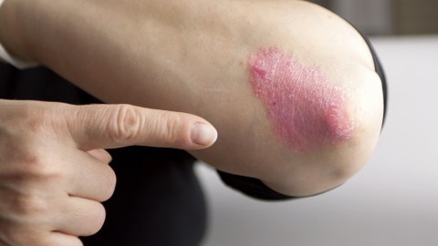 La psoriasis se presenta más que todo en codos, rodillas, cuero cabelludo, manos y pies.