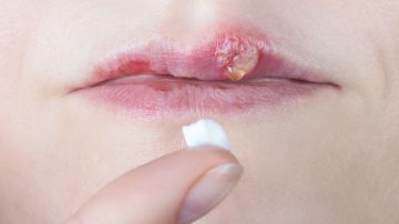 Los granos del herpes labial se van solos, solo hay que tratarlos con hielo y con las cremas recetadas para ellos.