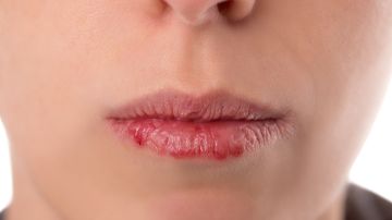 Los labios agrietados pueden llegar a sangrar.