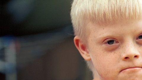 sindrome down