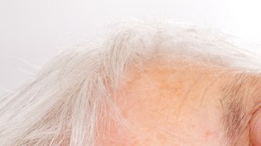alzheimer