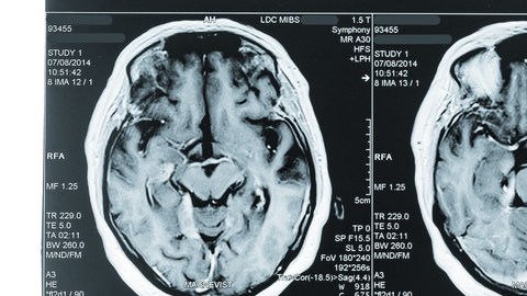 cancer cerebro