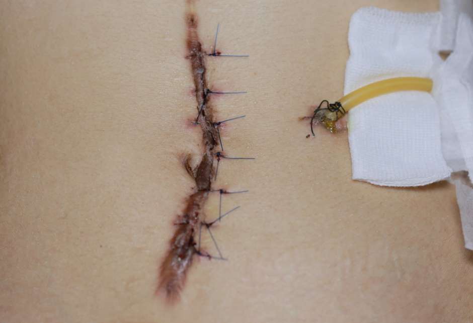 cicatriz cancer piel