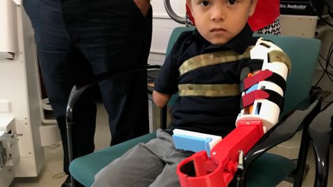 El niño hondureño de tres años, Isaac Cruz, se convirtió en el paciente más pequeñoen recibir una prótesis creada con tecnología de impresión en 3D.