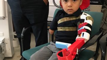 El niño hondureño de tres años, Isaac Cruz, se convirtió en el paciente más pequeñoen recibir una prótesis creada con tecnología de impresión en 3D.