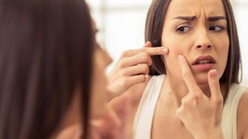 Se estima que entre un 15% y 30% de la población mayor de 25 años tiende a padecer acné tardío, siendo las mujeres las más afectadas.