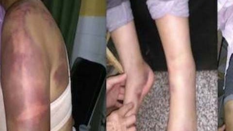 El hombre golpeó a su pareja en todo su cuerpo.