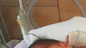 Eiko, que se ve aquí en la UCI neonatal del Hospital Mount Sinai, fue dada por cesárea el 19 de agosto, más de dos meses después de haber sido operada dentro del útero de su madre.