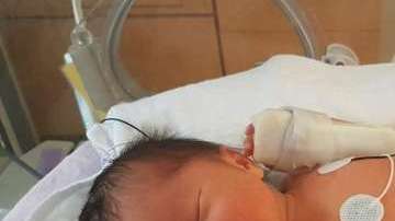 Eiko, que se ve aquí en la UCI neonatal del Hospital Mount Sinai, fue dada por cesárea el 19 de agosto, más de dos meses después de haber sido operada dentro del útero de su madre.