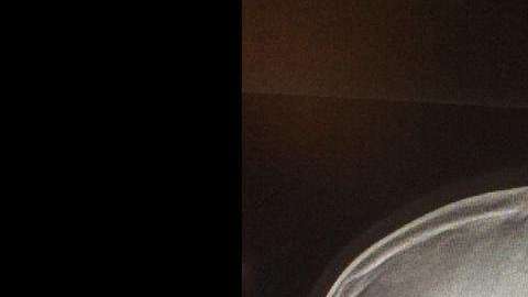 Un niño de 13 años se clava un tornillo. Afortunadamente, se salvó de morir.