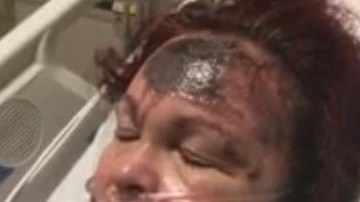 Se desconoce por qué la mujer se quemó el rostro.