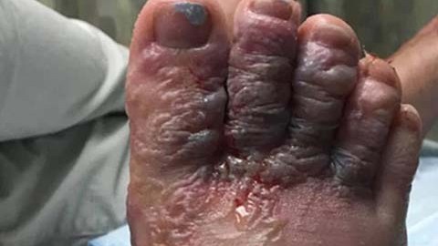 Debido a la infección, Eddie Zytner y Katie Stephens deben andar con muletas.